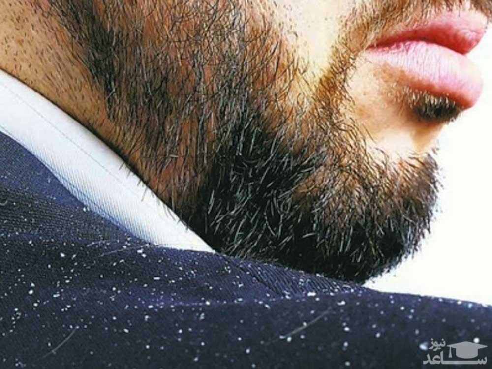 راه رهایی از شوره ی ریش مردان