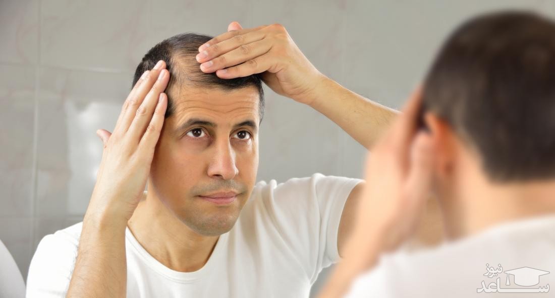در مورد ریزش مو در مردان چه میدانید؟