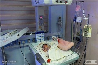 خطر ابتلای کودک به آرتروز در زایمان های زودرس