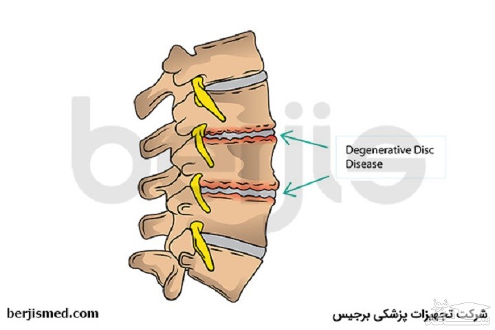 بیماری دژنراتیو دیسک چیست و علائم آن کدامند؟