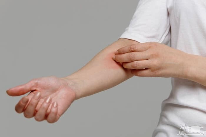 التهاب پوست