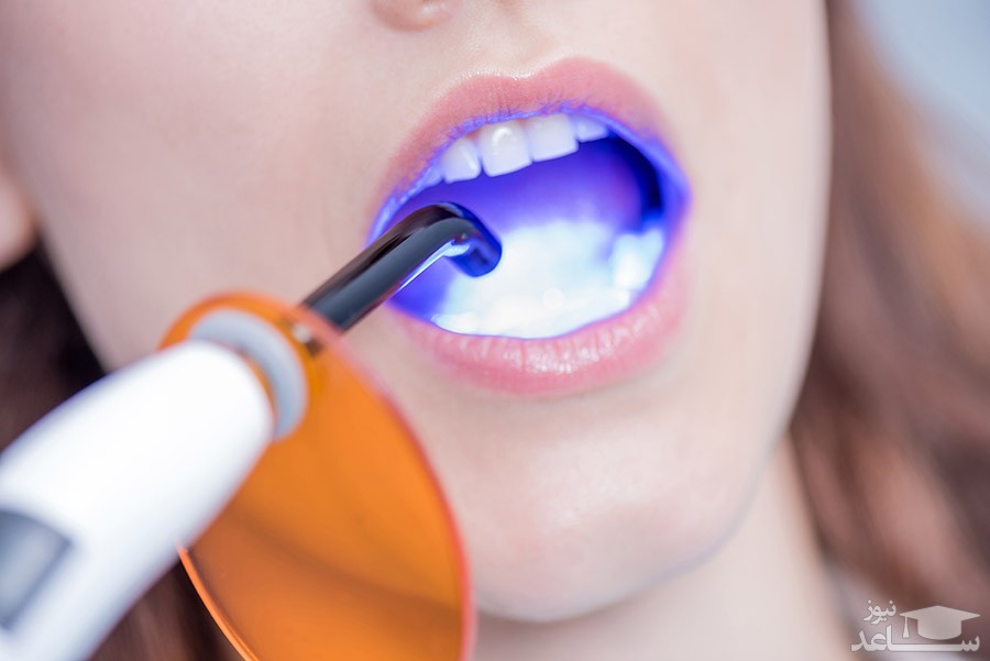 چگونه از دندان های حساس خود مراقبت كنیم ؟
