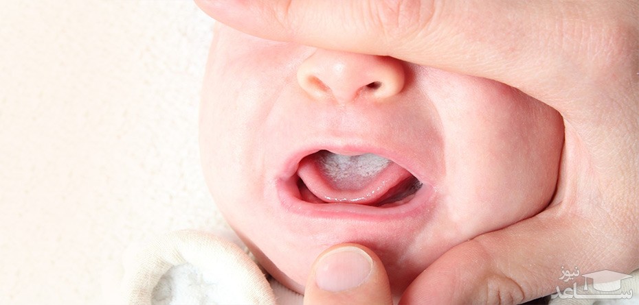 علت برفک زدن دهان نوزاد و روش های درمان