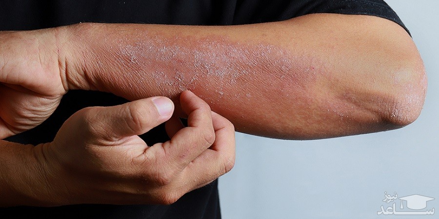 علائم بیماری اگزما یا خارش پوست و راه های درمان آن
