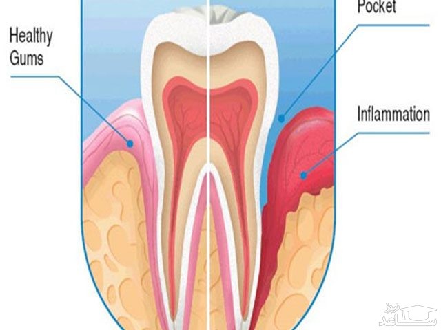 پریودنتیت چیست؟