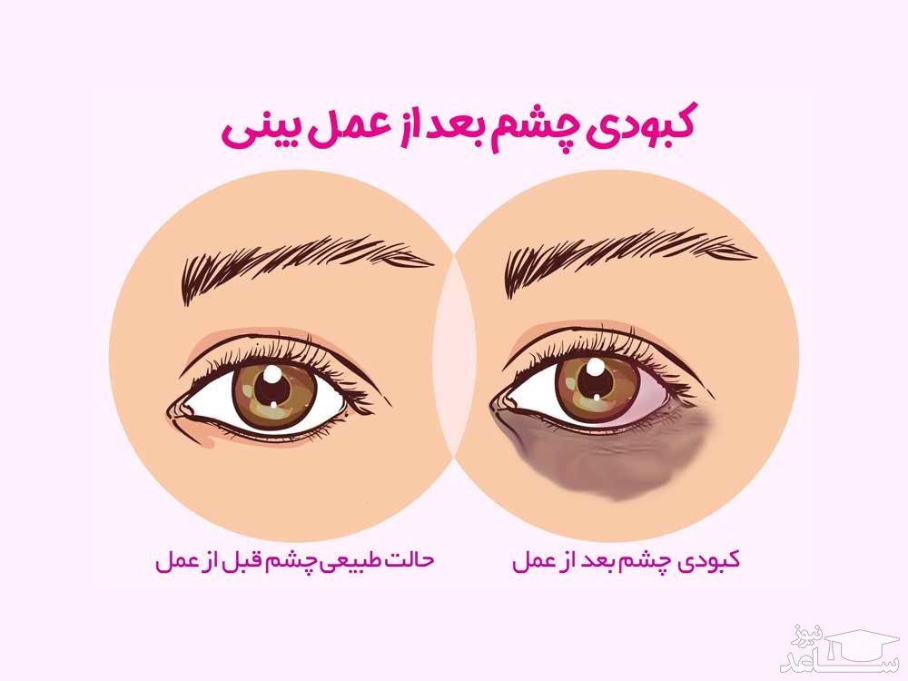 عوارض اپیکانتوپلاستی