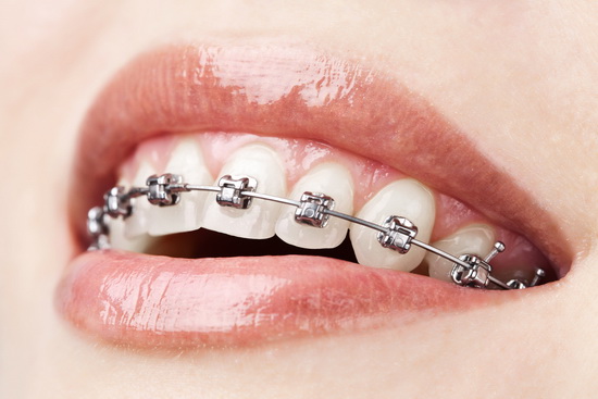 ارتودنسی باعث افزایش طول عمر دندان ها می شود