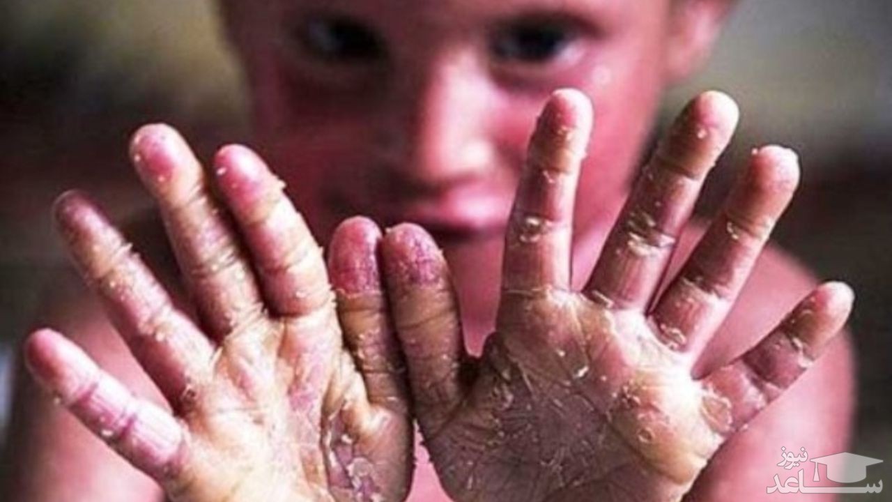 ورود کمیسیون بهداشت به موضوع گم شدن ۲۵۰۰ کیلو پانسمان بیماران پروانه‌ای