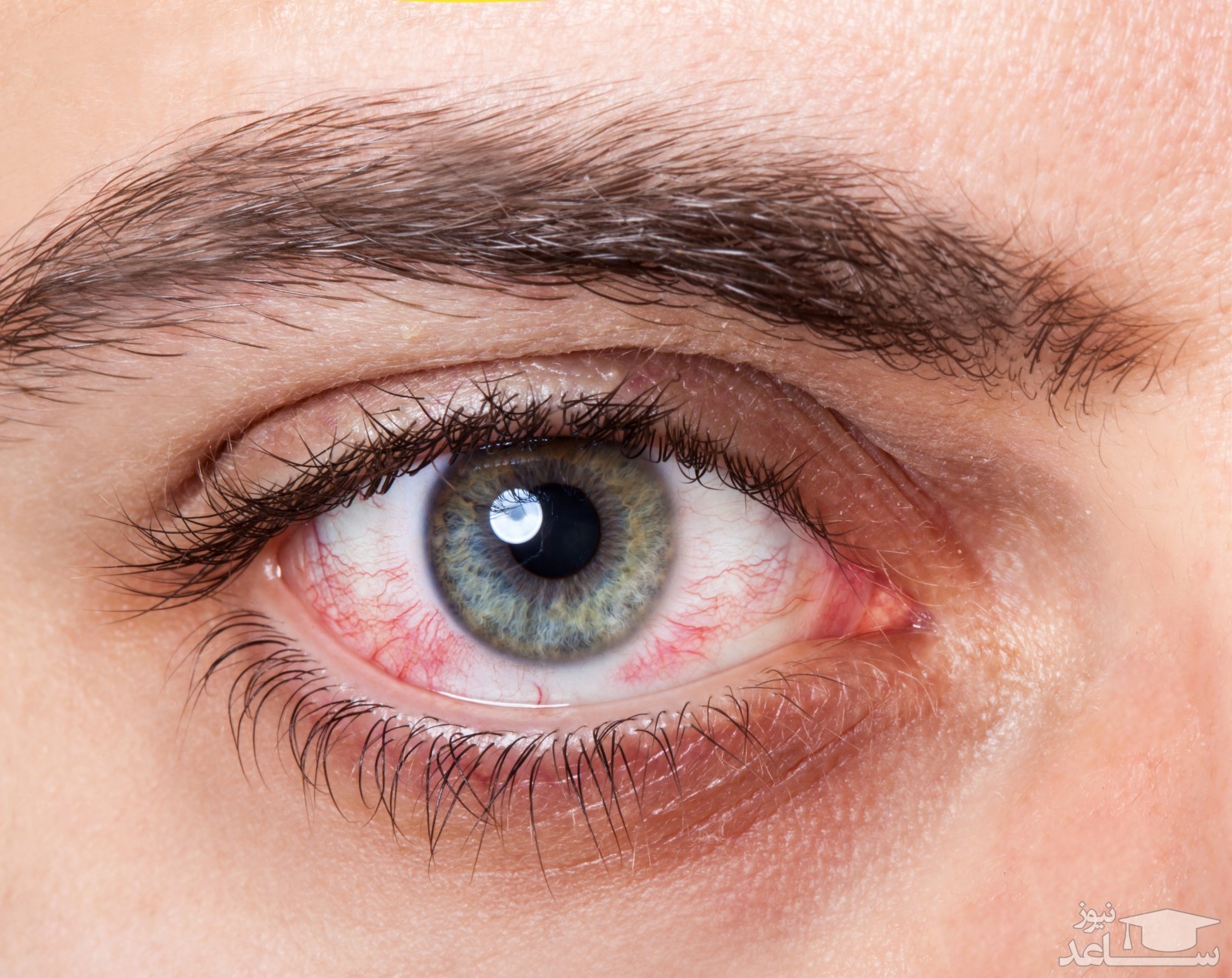 بیماری زخم قرنیه ی چشمی چیست؟