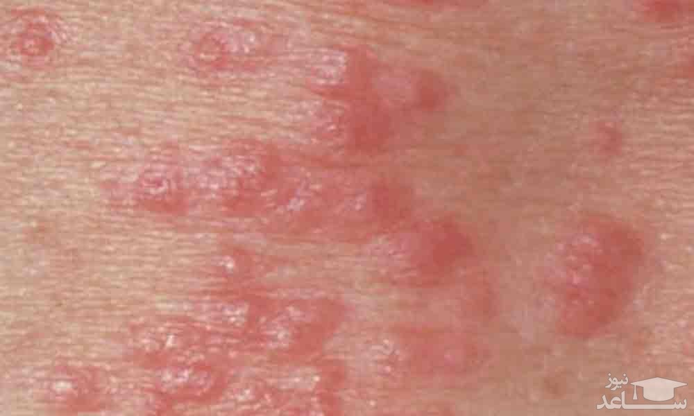 راه های انتقال ویروس اچ پی وی  HPV