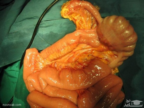 علت پاره شدن آپاندیسیت چیست ؟