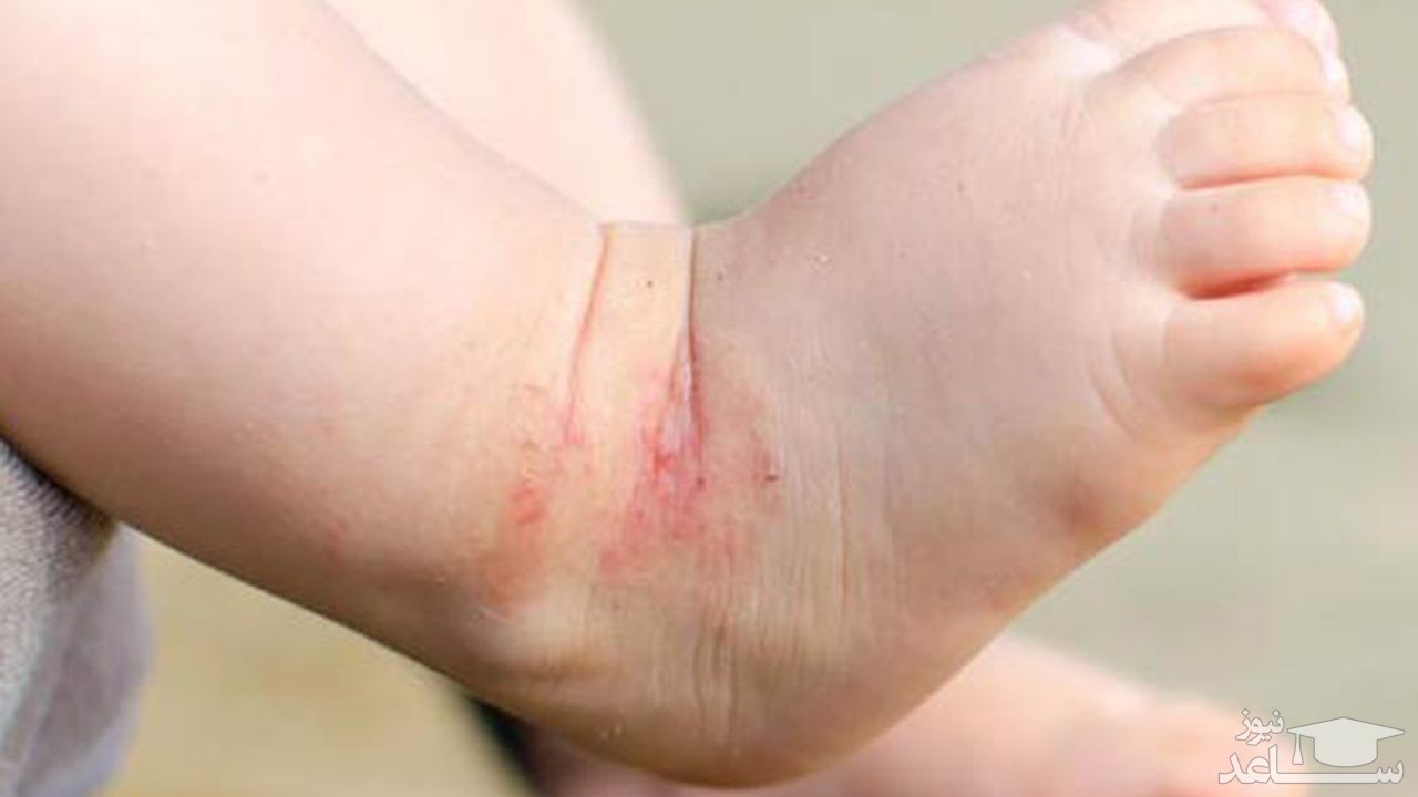 10 روش برای درمان بیماری اگزما در فصل زمستان
