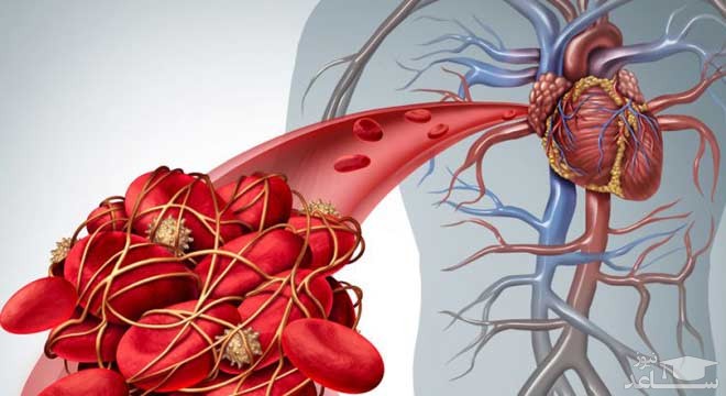 فشار خون ریوی مزمن