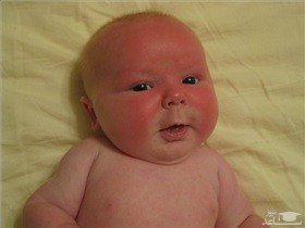 روش های پیشگیری و درمان آفتاب سوختگی کودکان