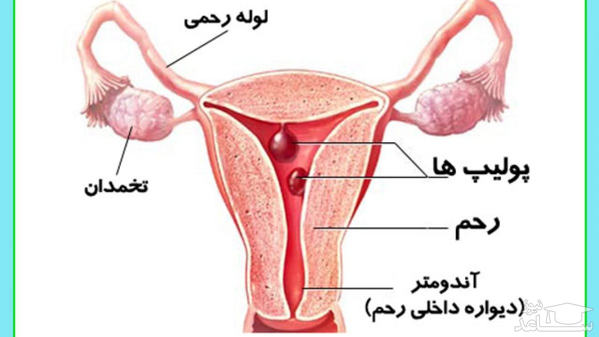 تشریح پولیپ رحم 