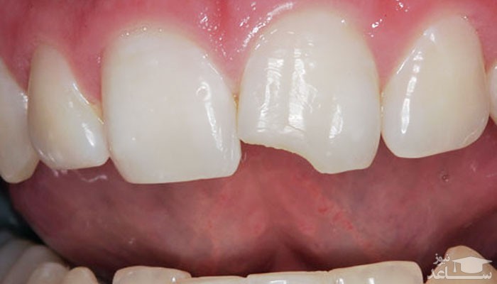 با دندان شکسته یا کنده شده چکار کنیم؟