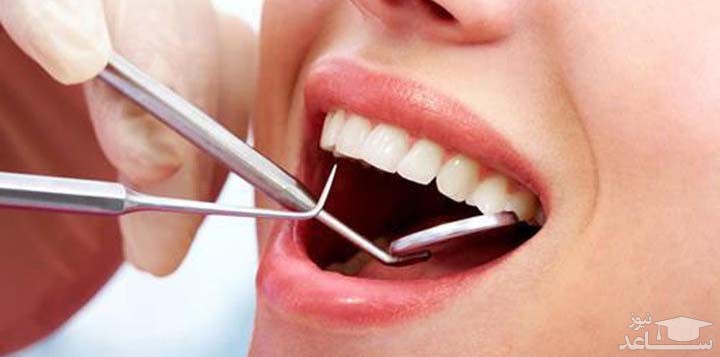 با انواع کامپوزیت دندان آشنا شوید