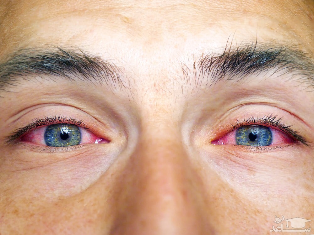 لکه خونی در چشم چیست؟