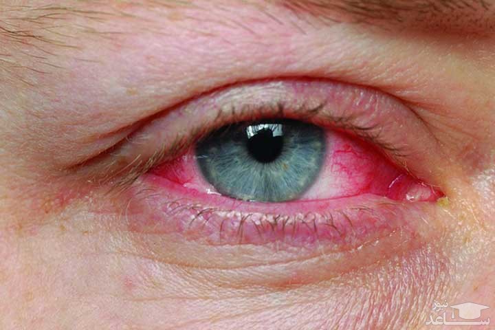 بیماری قرمزی چشم چیست؟