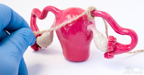 روشهای بستن لوله های رحم در زنان و عوارض آن