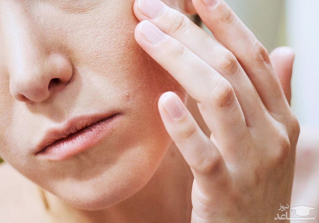 8 درمان خانگی معجزه آسا برای اگزما