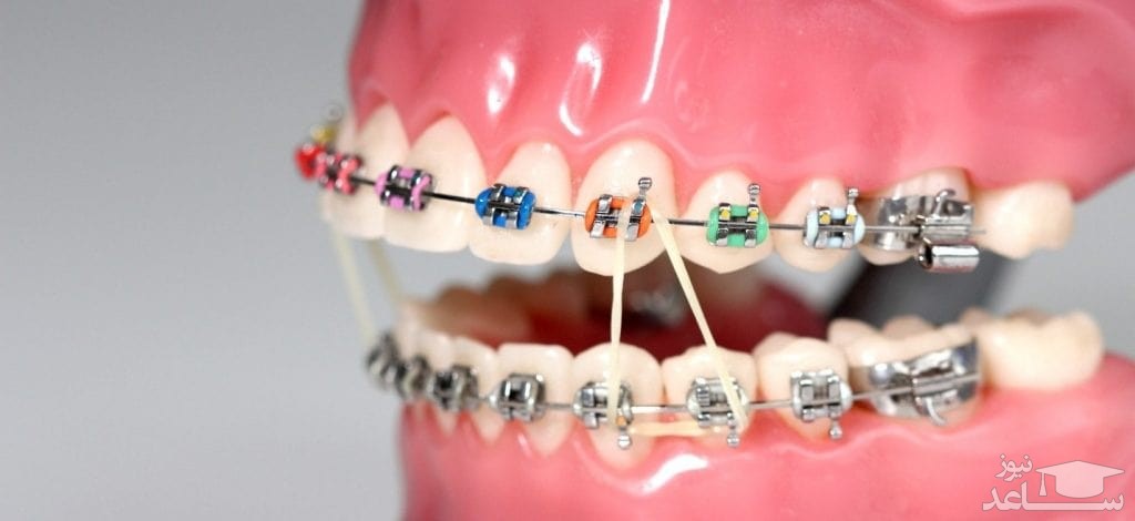 ارتودنسی برای یک دندان امکان پذیر است؟