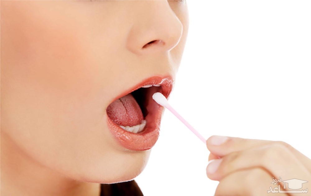 زگیل دهانی چیست ؟