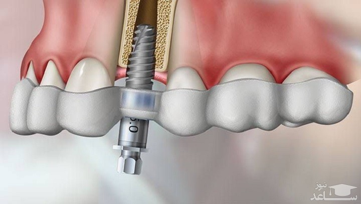 آیا ایمپلنت و کاشت دندان بدون درد واقعا بدون درد است؟