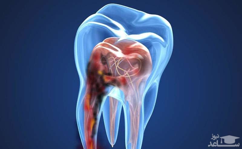 برای دندان درد شدید چه باید کرد؟