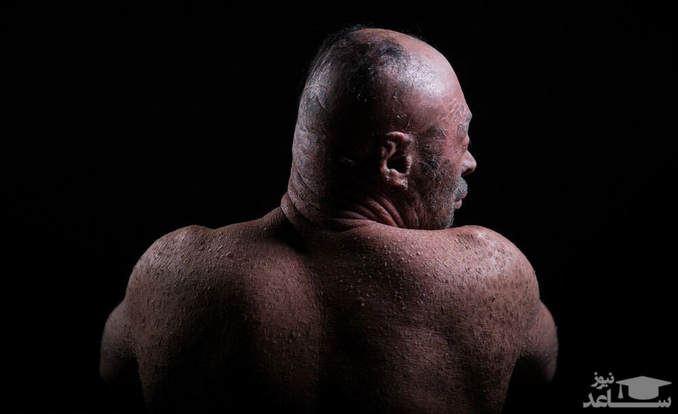 (تصاویر + 16) تصاویر دردناک از مردی با پوست پولکی
