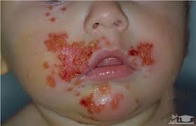 علل بیماری زرد زخم در کودکان و راههای درمان آن