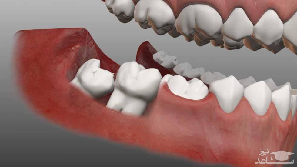 قبل از کشیدن دندان عقل، بخوانید!