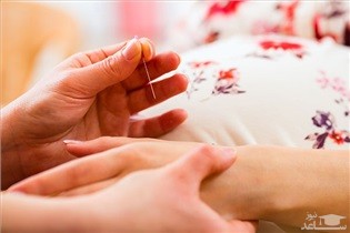 کاهش دردهای بارداری با طب سوزنی