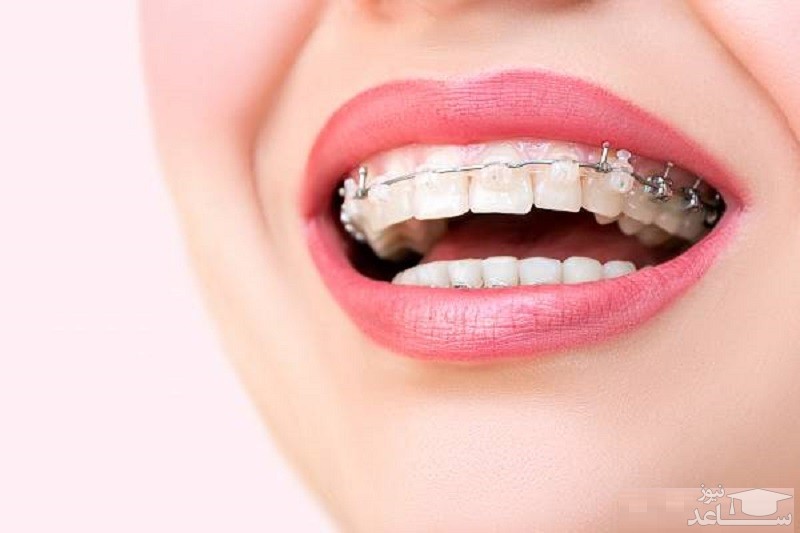 درمان ارتودنسی دندان و عوارض آن