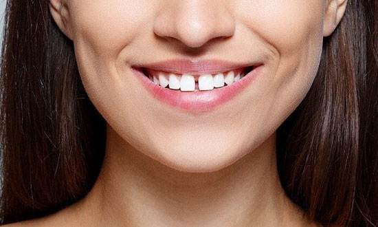 روش های درمان دندان های فاصله دار