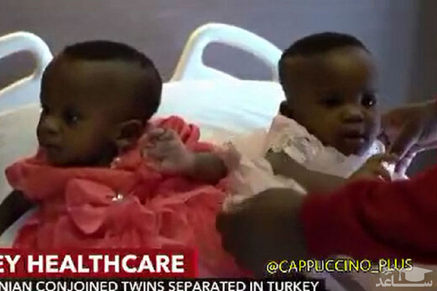 (فیلم) خواهران دوقلوی به هم چسبیده که بعد از ۲۷ ساعت عمل جراحی جدا شدند!