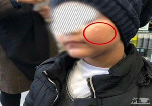 ماجرای سوزاندن صورت یک پسر بچه با کفگیر در مهد کودک رامسر؟