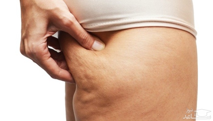 درمان خانگی و گیاهی سلولیت ( تجمع چربی ها در زیر پوست)