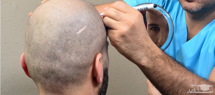 قیمت کاشت مو: چه عواملی روی هزینه آن تاثیر می گذارند؟