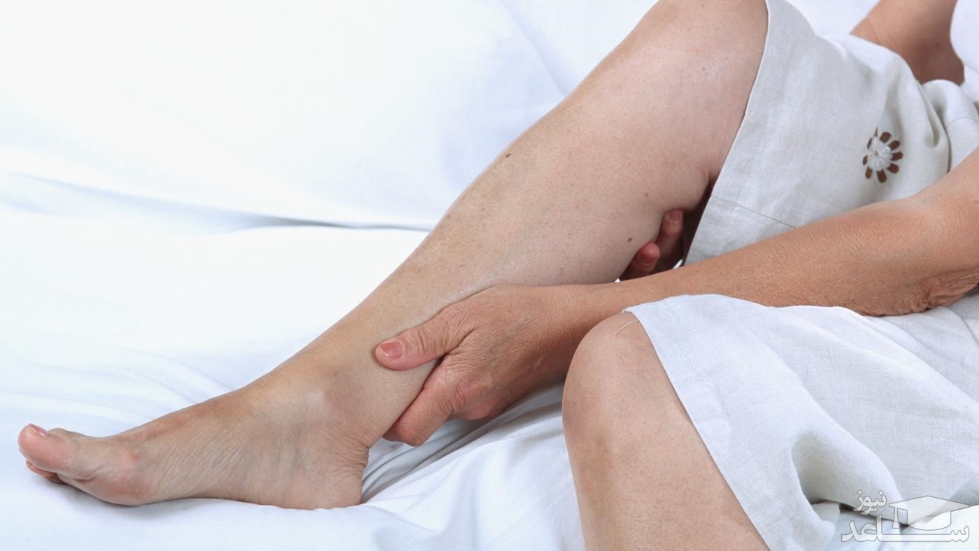 راه های درمان و پیشگیری از واریس پا