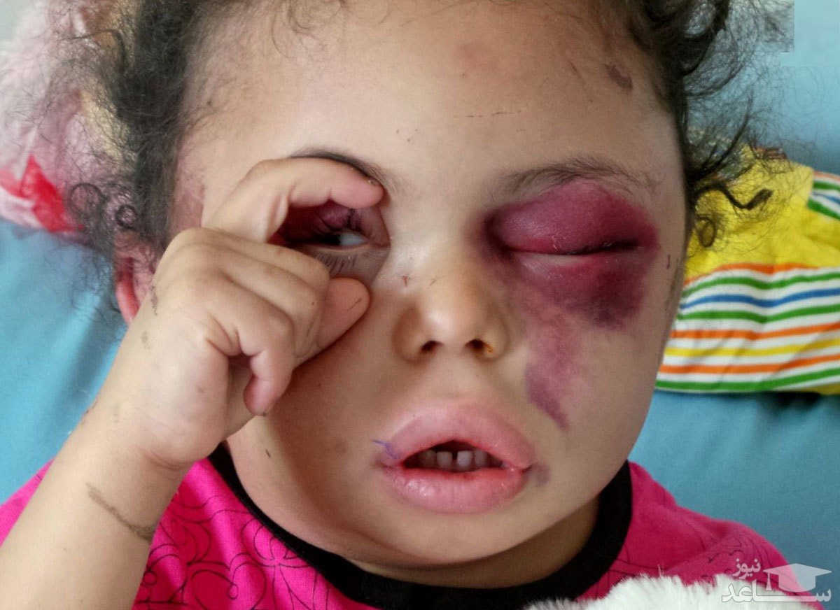 داستان تلخ دختری که نماد یک جنگ شد