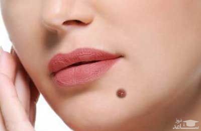 خال های سرطانی کدامند و چگونه شناسایی میشود؟