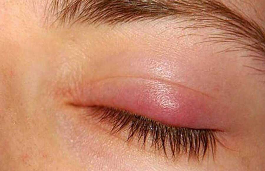 بیماری های رایج پلک چشم