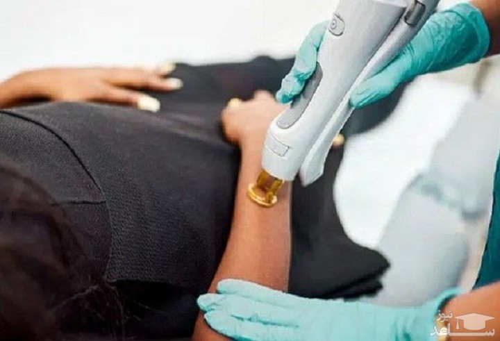 دلایل برگشت مو بعد از لیزر + راز هایی که درباره لیزر به شما نمی گویند!