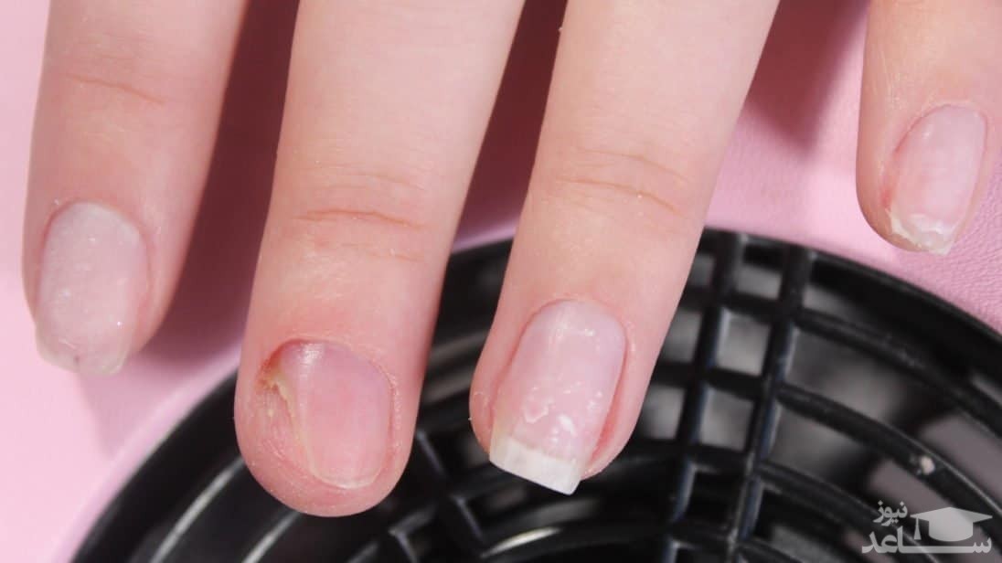 روش هایی برای مراقبت از ناخن ها و جلوگیری از عفونت آن ها