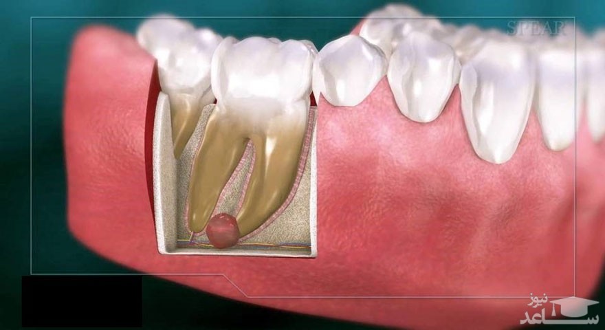 درمان کیست دندان چگونه است؟
