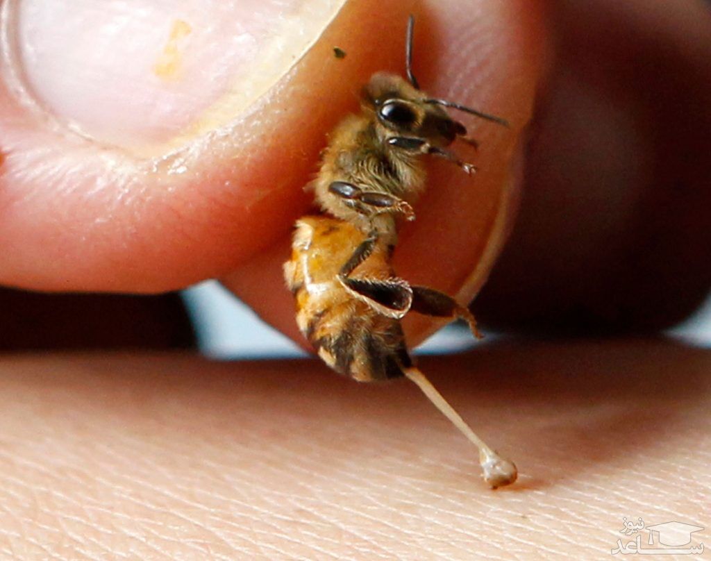 (فیلم) درمان دردناک بیماران با نیش زنبور عسل!
