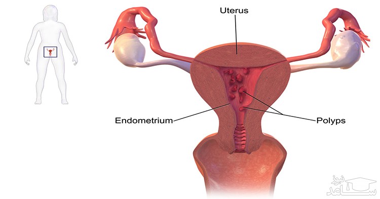 دلایل و علائم  پولیپ رحم در زنان