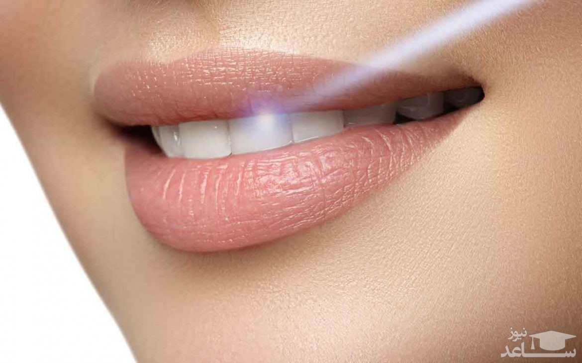 سفید کردن دندان با لیزر