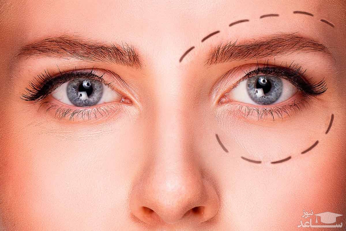 تاثیرگذارترین روش های خانگی برای درمان افتادگی پلک